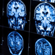 Illustration for article titled New Test Predicts Alzheimer's at Least Three Years in Advance